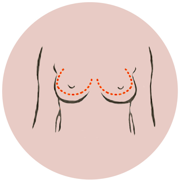 borstcorrecties-illustratie-rond.png