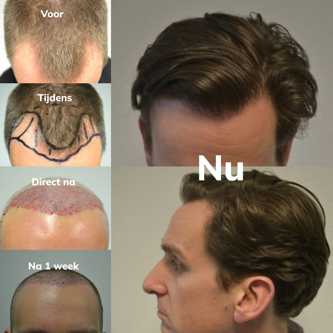 haartransplantatie-resultaat-voor-na.webp