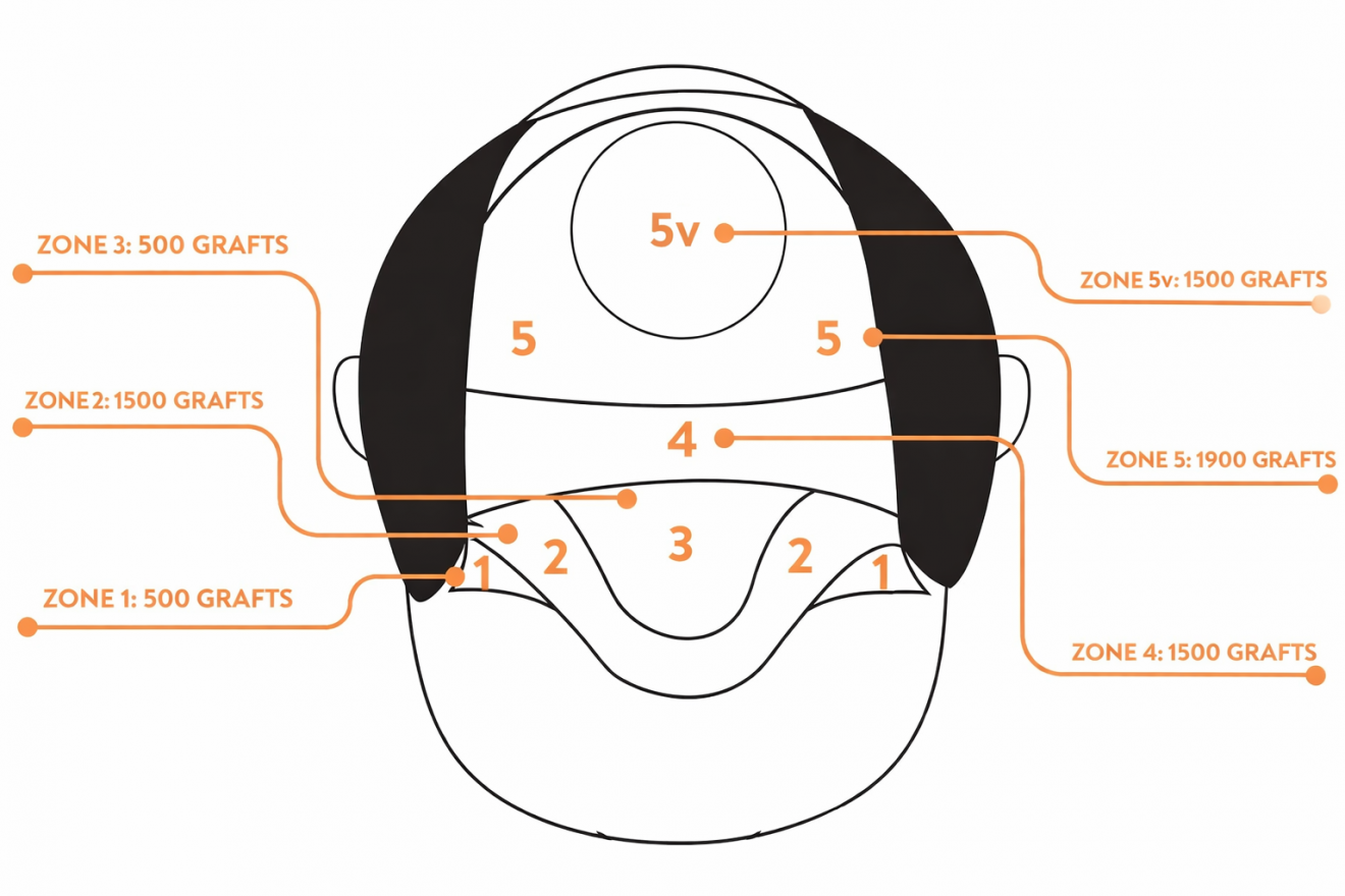 haartransplantatie-zones_001.png