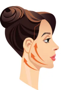 klassieke-facelift-illustratie-1-202x300.webp