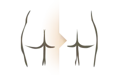 kv-ill-liposuctie_001.webp