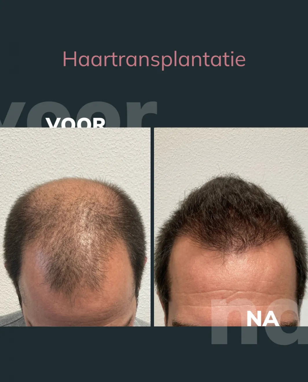 voor-en-na-haartransplantatie-2-1_001.webp