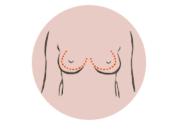borstcorrecties-illustratie-rond-v2_001.png
