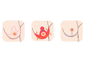 borstlift-illustratie-anker_001.png
