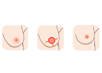 borstlift-illustratie-donut.png