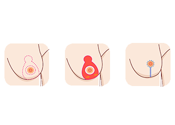 borstlift-illustratie-lollipop.png