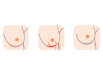 borstlift-illustratie-melon.png