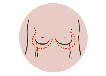 borstverkleining-illustratie-rond-v2_001.png
