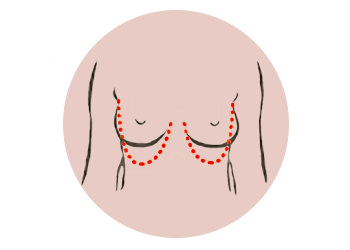 borstversteviging-illustratie-rond-v2_001.png