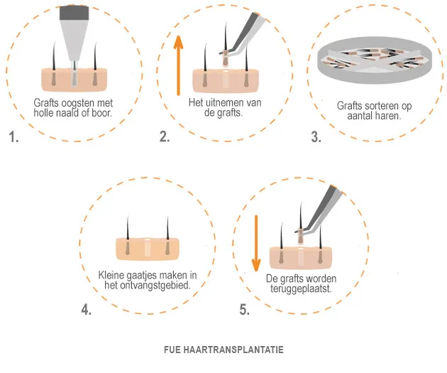 fue-haartransplantatie-v1-onderschrift_001.webp