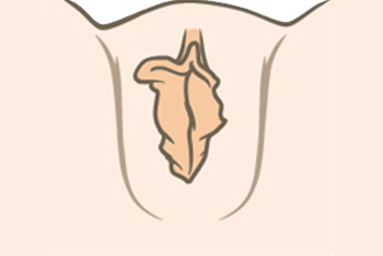 labiacorrectie-voor.png
