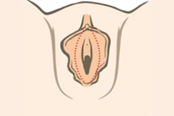 labiacorrectie-voor_002.png