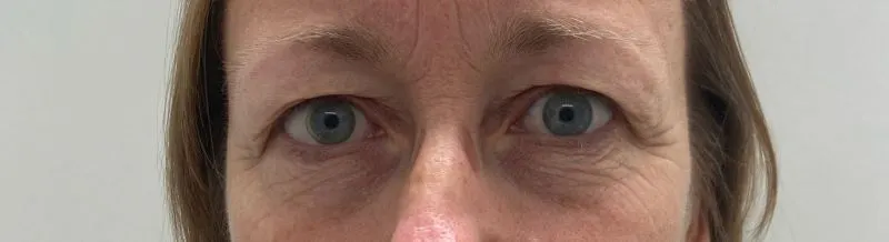 Voorfoto bovenooglidcorrectie 