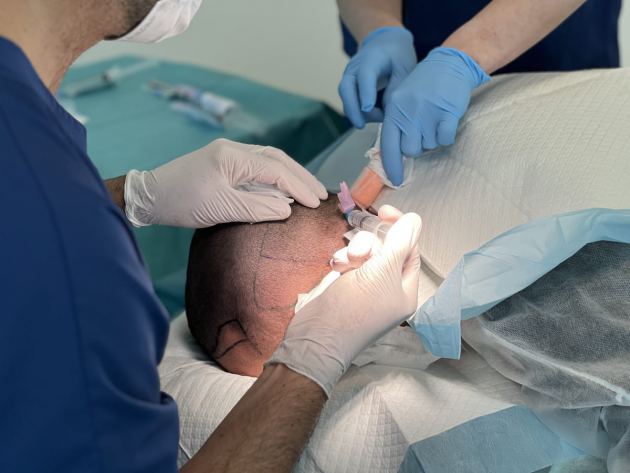 Een haartransplantatie gaf Tom een volle bos haar én meer zelfvertrouwen