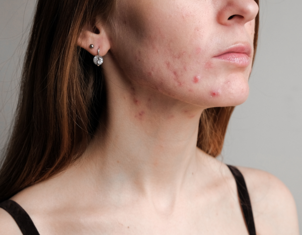 Wat is acne?