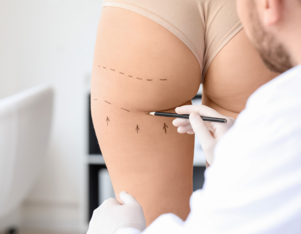 Hoe werkt liposuctie?