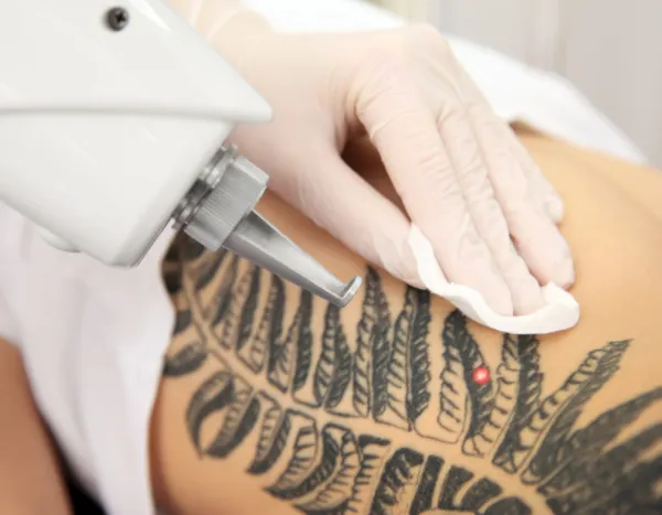 Tatoeage laseren in de zomer?