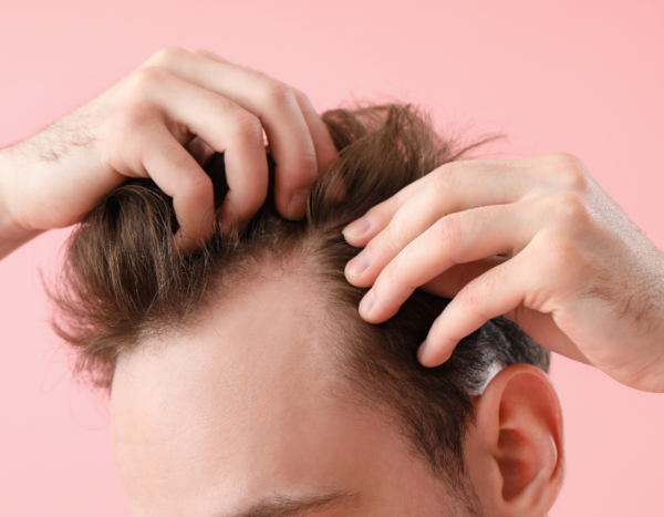 Haartransplantatie
