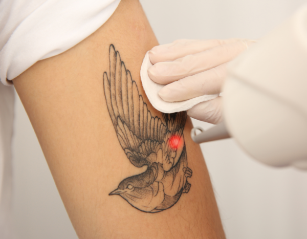 PicoWay krachtpatser in tattoo verwijderen