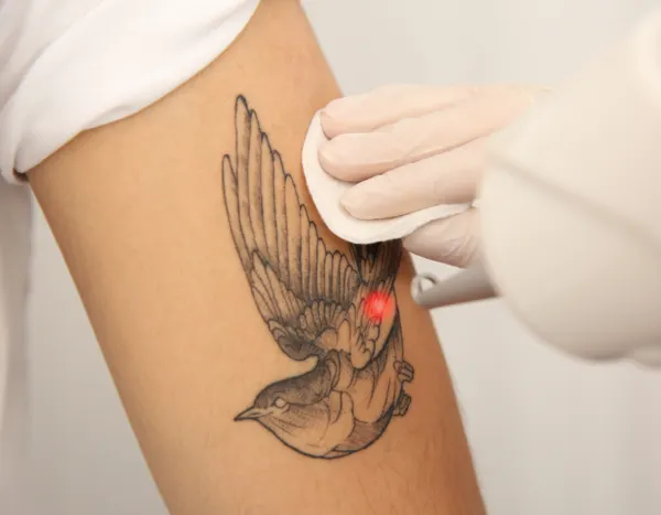 PicoWay krachtpatser in tattoo verwijderen