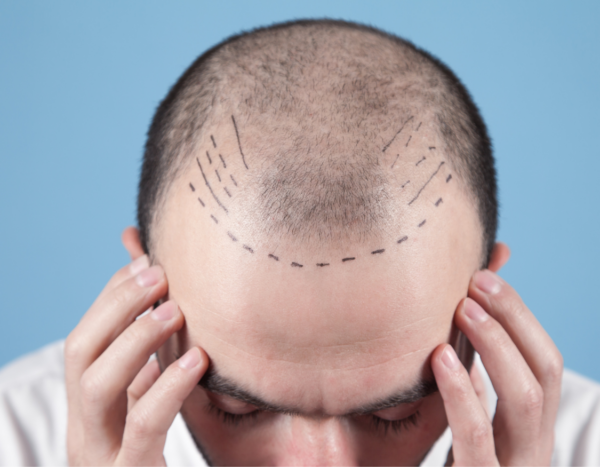 Goed donorgebied voor een haartransplantatie?