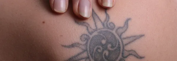 Kies de juiste kliniek! Kans op verminking door tattoo verwijderen